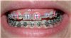 braces_smile